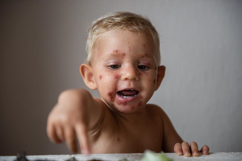 Impetigo
