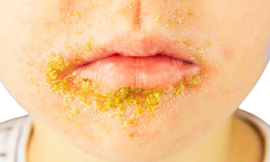 Impetigo
